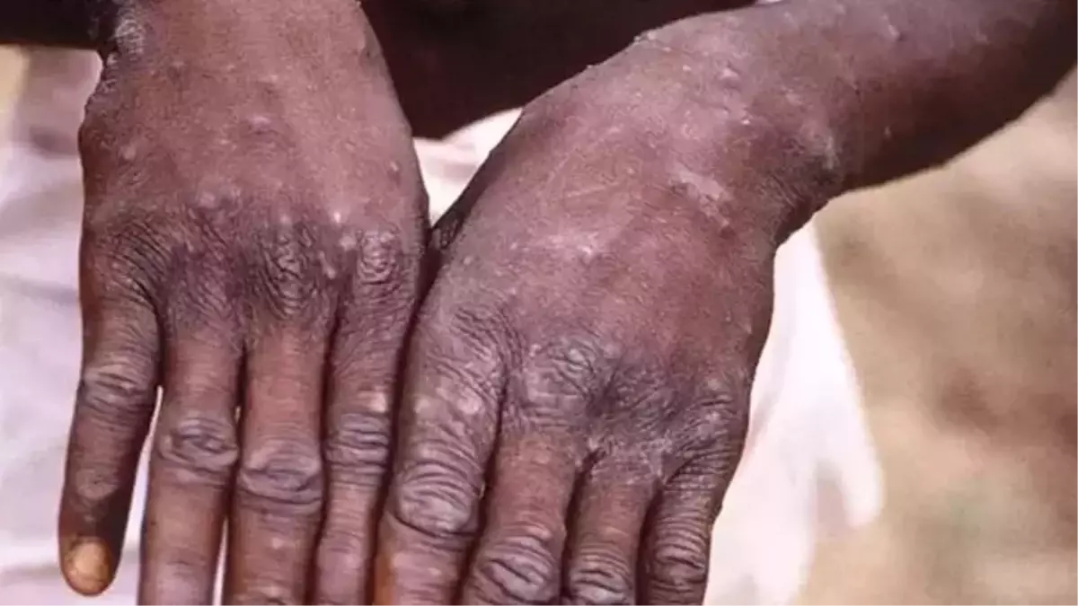 Sierra Leone’de Maymun Çiçeği Virüsü Nedeniyle Acil Durum İlan Edildi
